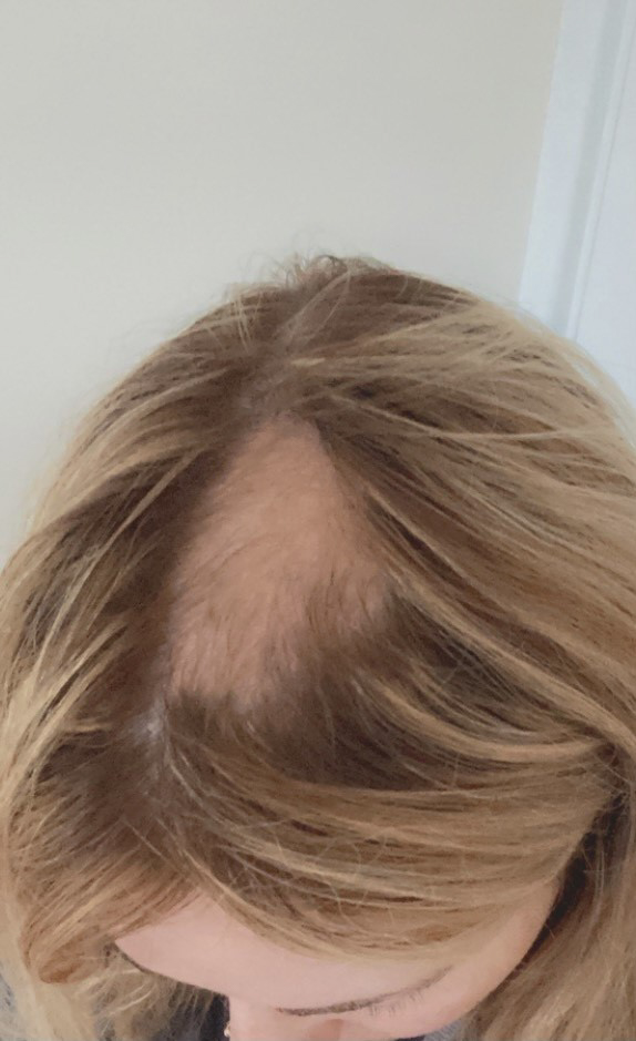 Her GP said she was likely to have lost the hair due to being very stressed