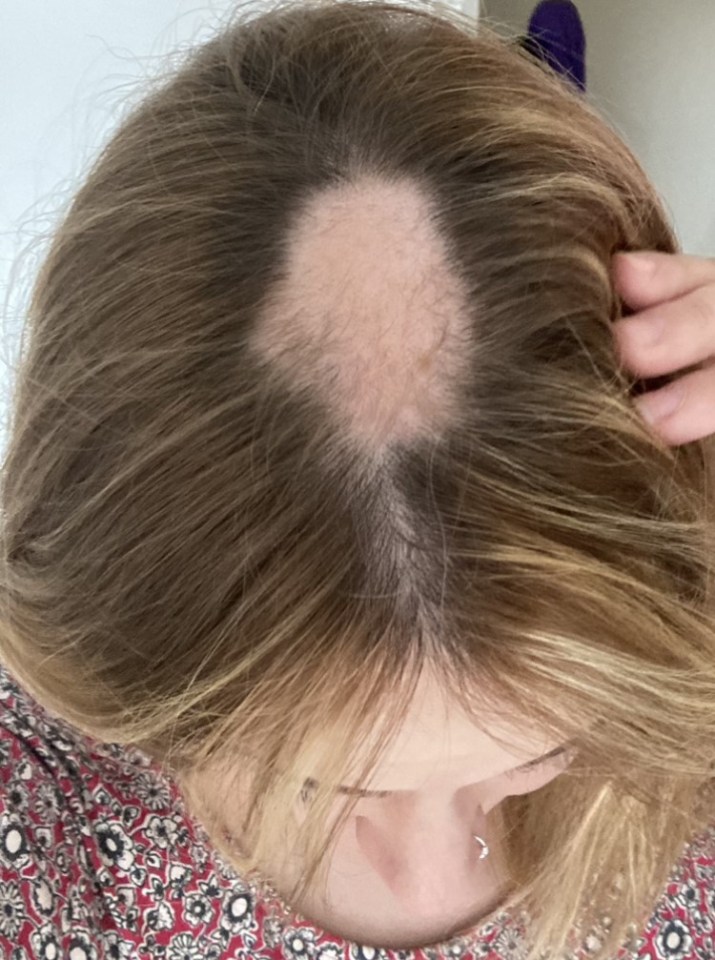 Charlotte Hawksley lost clumps of hair after being stressed about Covid