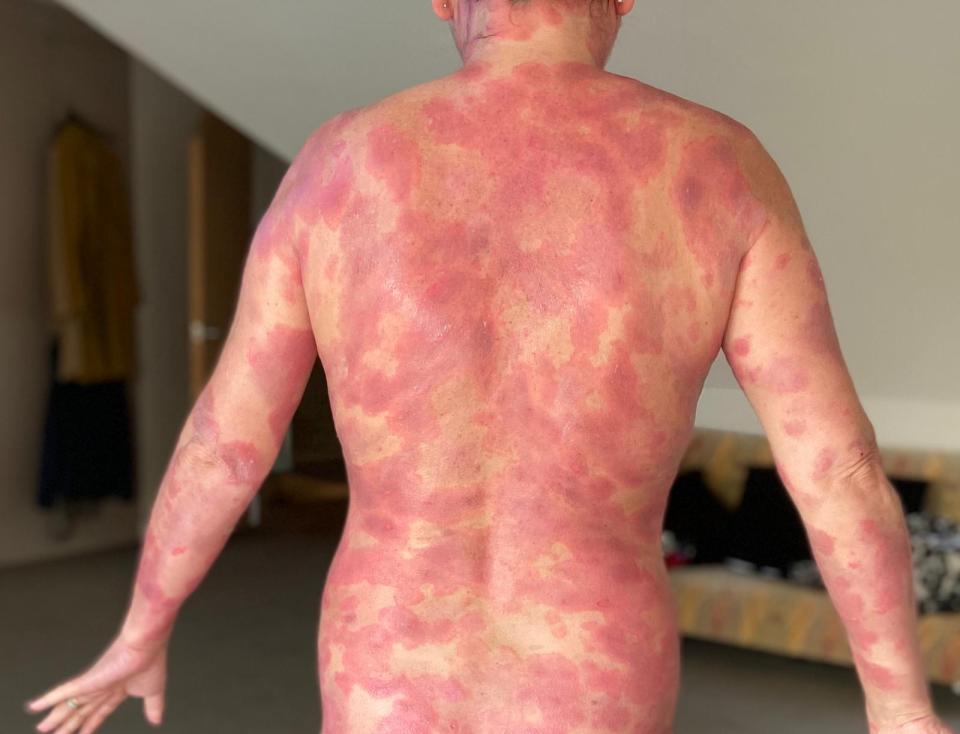 Lisa had struggled with her skin issues and found it difficult to regulate her temperature