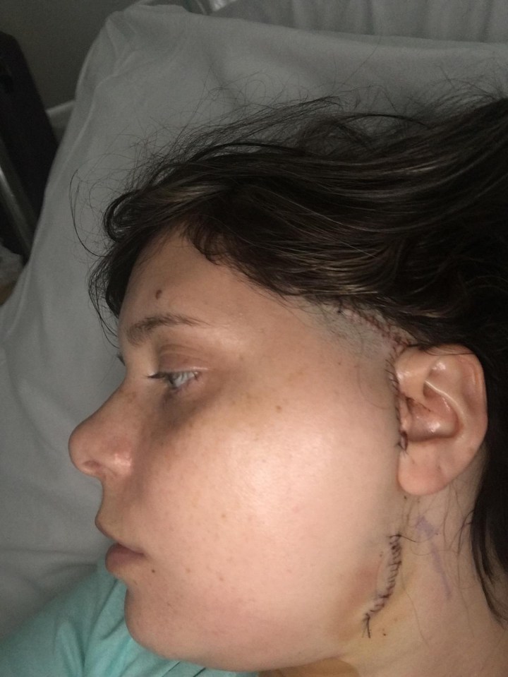 The mum-of-one, who lives in Portsmouth, Hampshire, has a scar along her left jawline where she was operated on in 2017