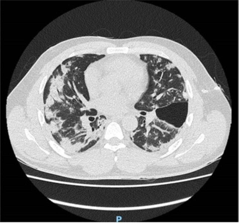 The man had a thoracic CT scan a day after being admitted. The patchy areas are thought to be Covid-19 infection