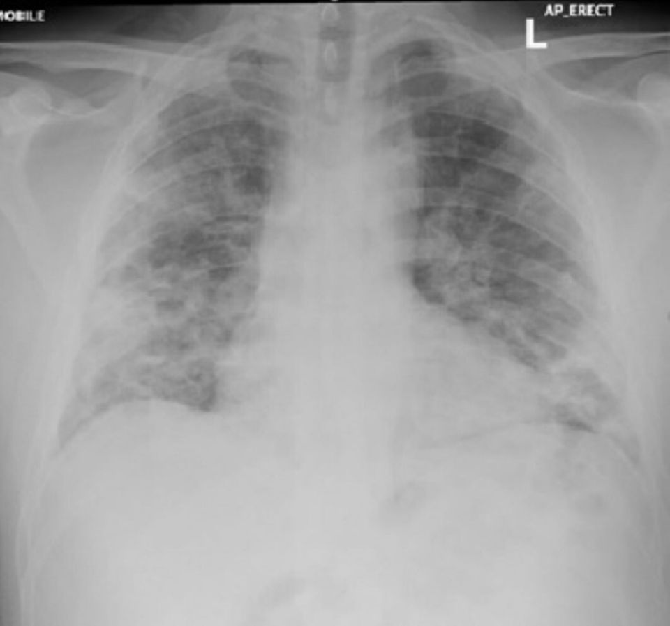 Scans taken by the experts showed the Covid having spread across the lungs