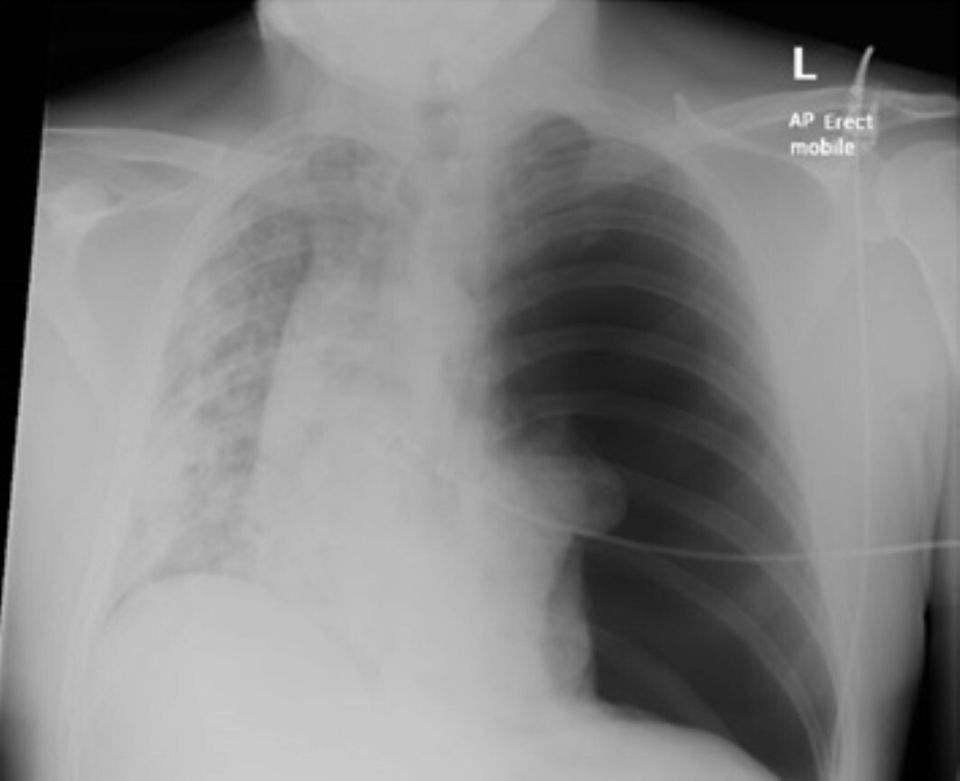 The image above is from a chest radiograph which shows tension on the left side, where it was eventually found that the patient had a collapsed lung