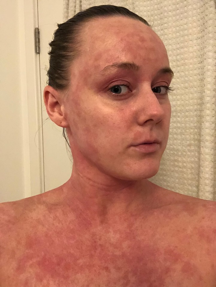 Beth Norman, 31, (pictured in July 2020) said stopping treatment for her eczema made her smell like a "wet dog"