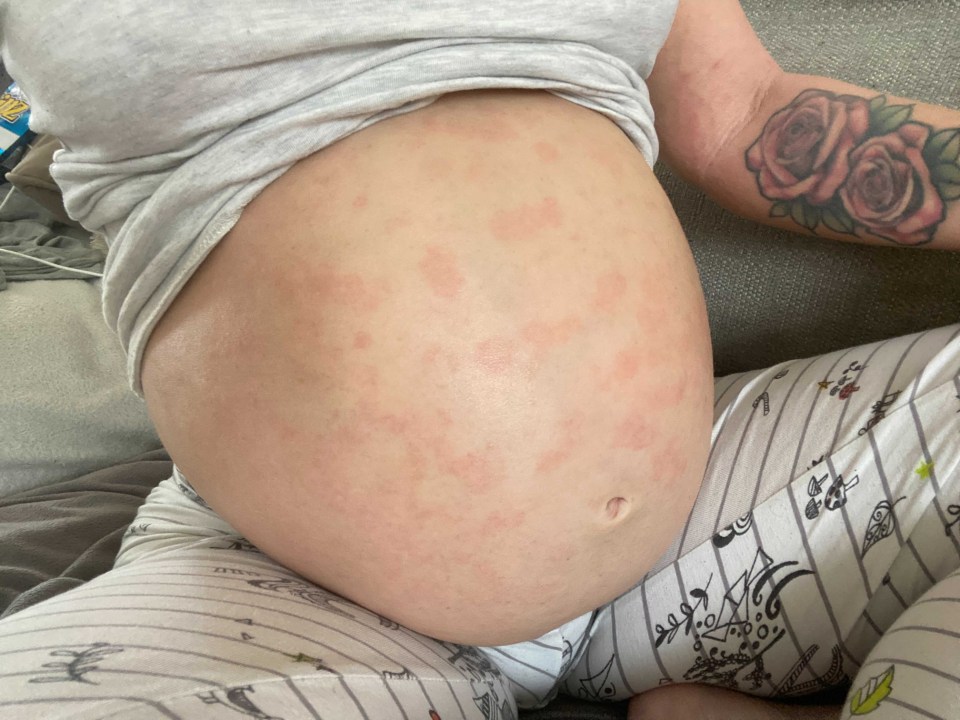 Beth said: “I have currently endured 11 months steroid-free without medical acknowledgment for my skin, while also growing a baby for six months"