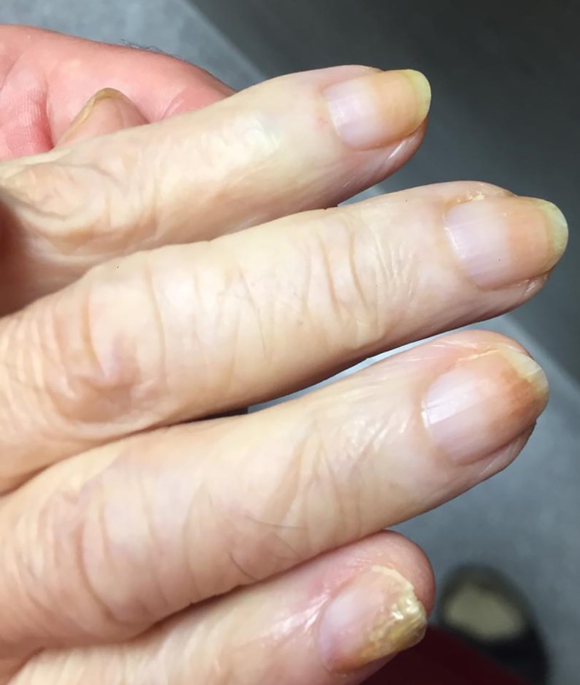 Nails of a Covid patient 16 weeks after disease diagnosis showing orange tips