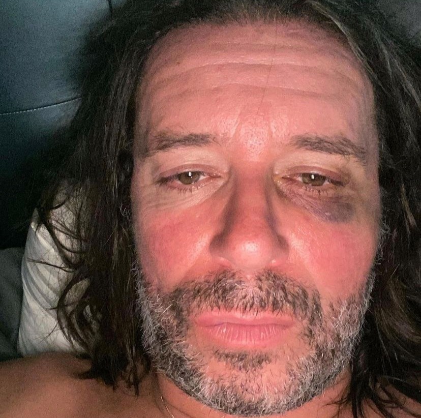 Alan Carr’s husband Paul Drayton has posted a shocking photograph of himself with a black eye