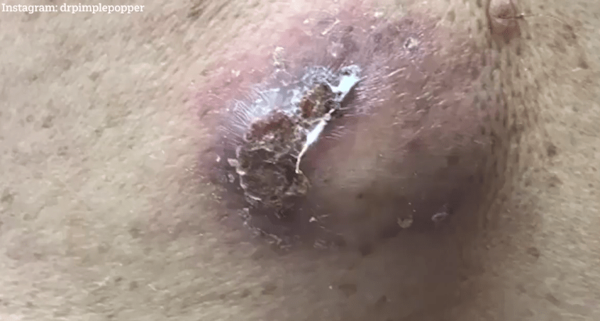 When the video starts, it looks like a bit of dry skin, or a spot that has scabbed over