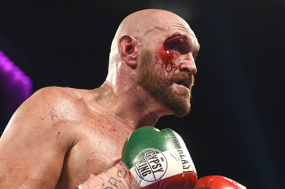 Tyson Fury's cut required 47 stitches after his fight with Otto Wallin