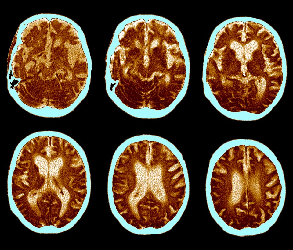 The brain disease slowly wipes the memory over several years