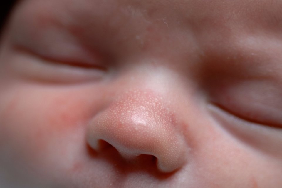 Nearly half of all newborns will have milk spots