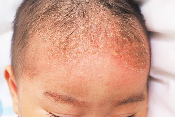 Cradle cap