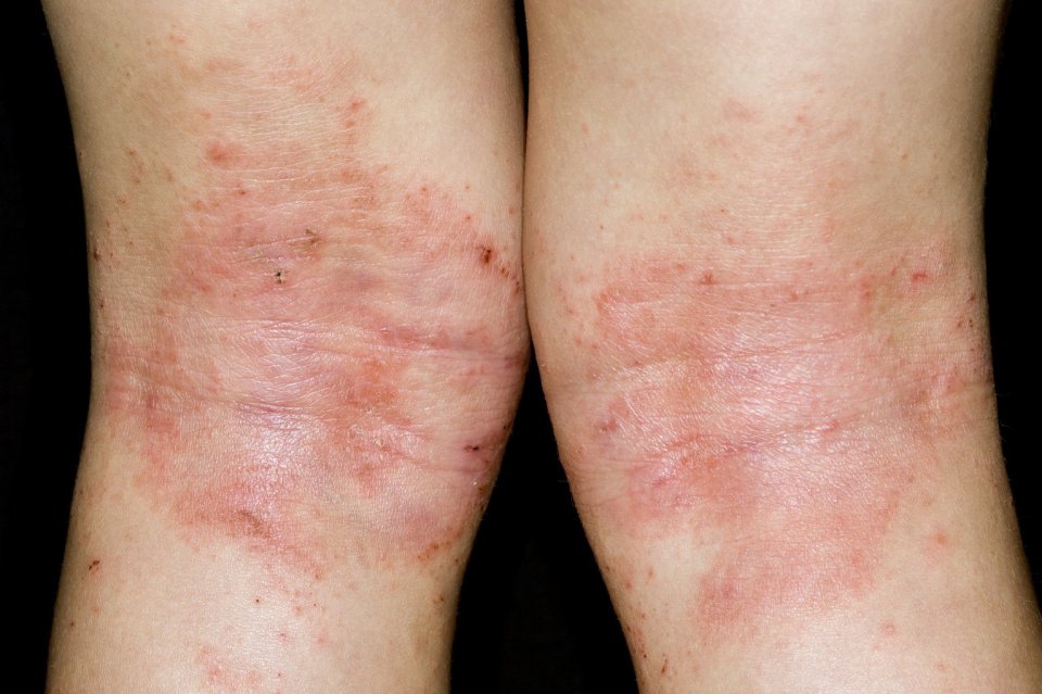 The backs of the knees are a common site for eczema