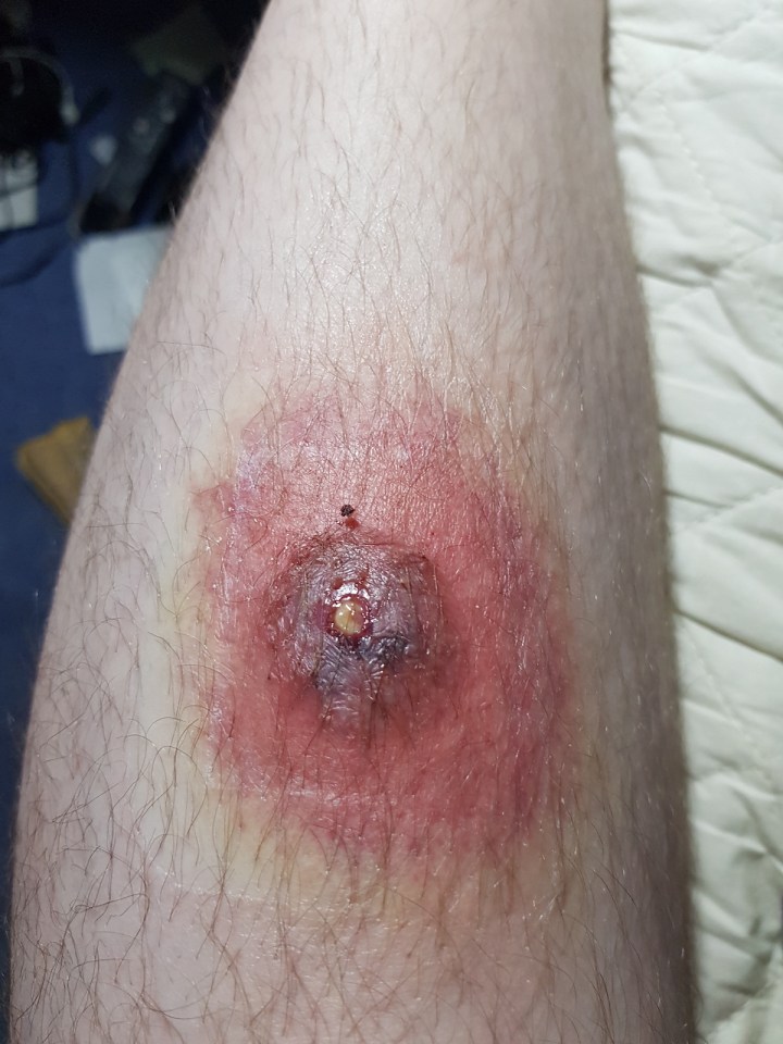 False widow bites can be sore, itchy, swollen and in some cases even lead to hospitalisation