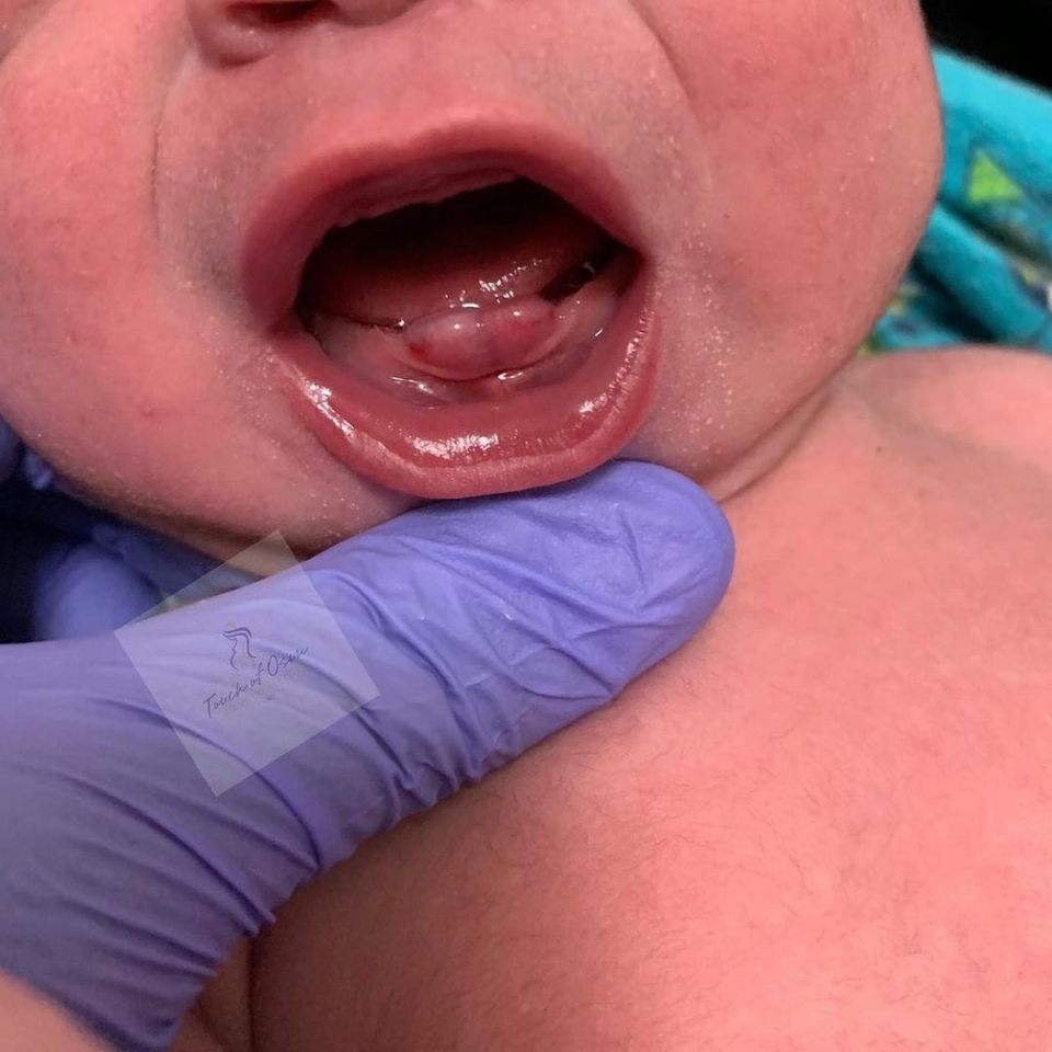 A midwife posted a picture of a newborn with teeth