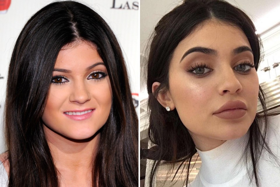 Kylie Jenner admitted she took fillers too far and had them dissolved