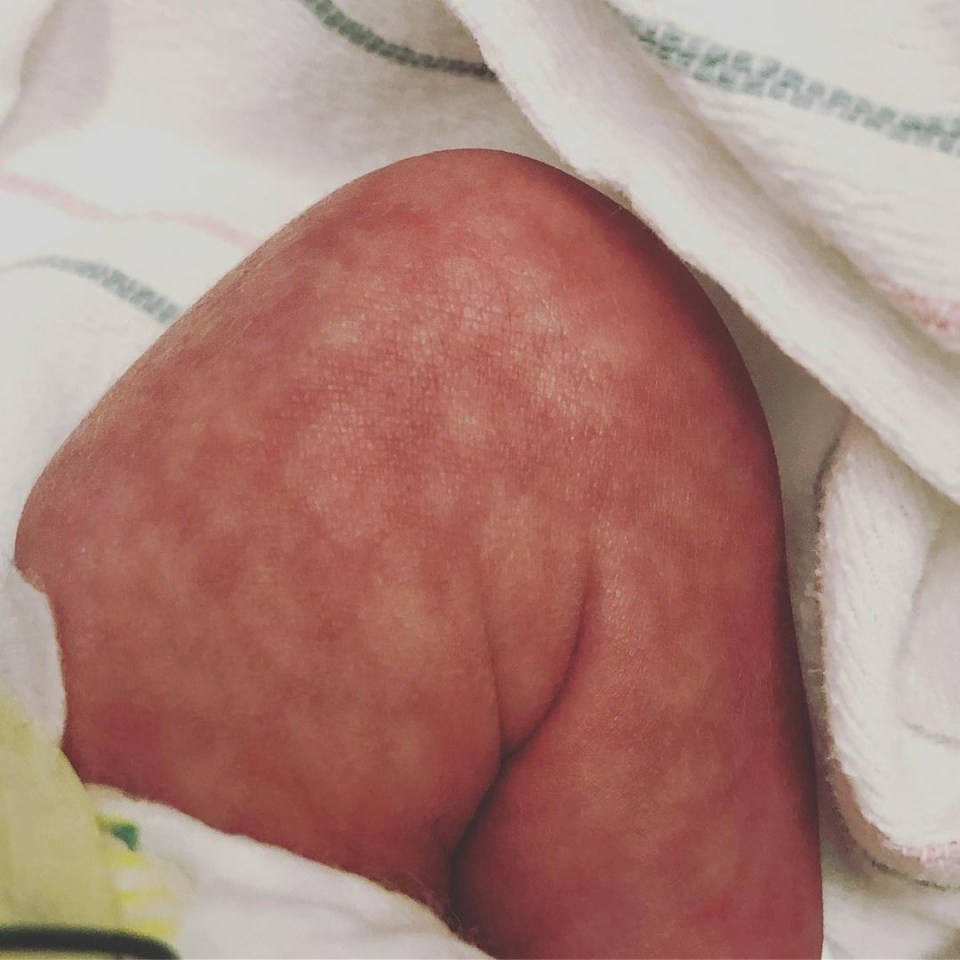 One expert has explained why your baby might have mottled skin