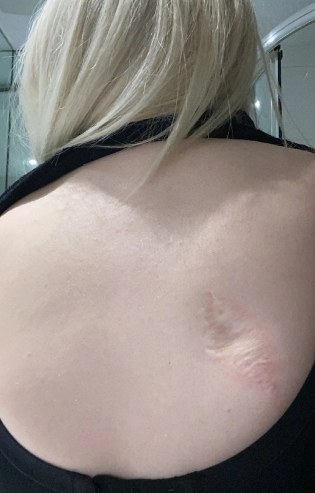 The scar on Daniella’s back where the cancerous tissue was removed