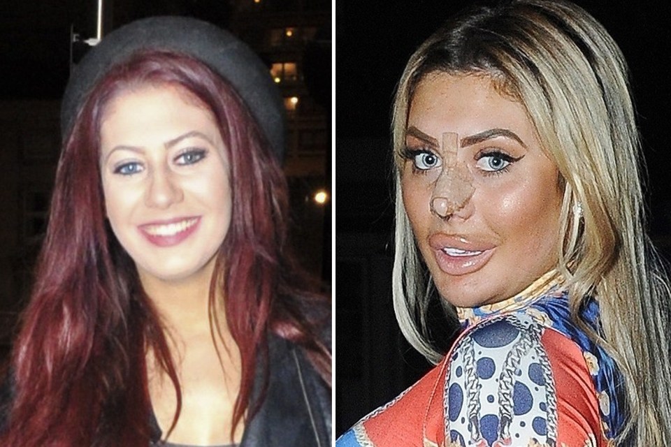 Chloe Ferry looks dramatically different after two nose jobs