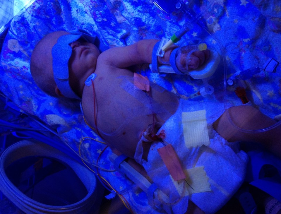 Finlay in NICU. Nicola said: "It became clear about four hours after his birth that there were too many of the antibodies from me lingering and destroying his red blood cells"