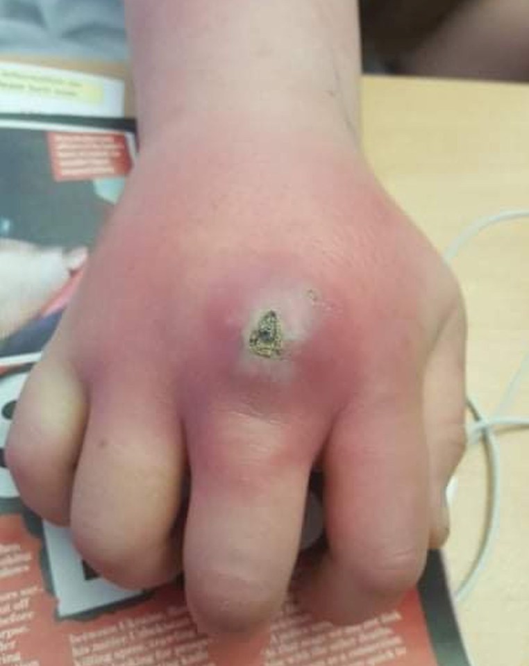 The nasty bite made her hand swell like a 'boxing glove'