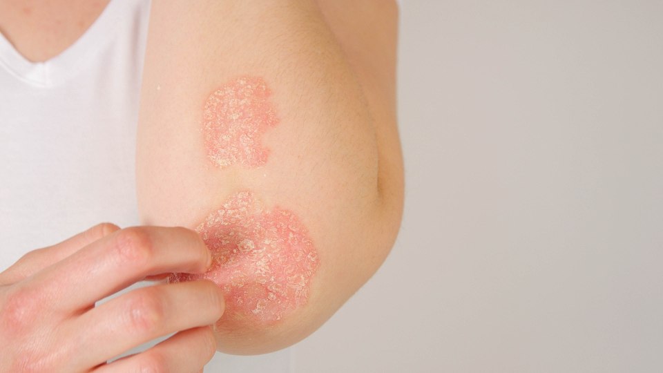 Psoriasis causes red patches of skin, sometimes itchy