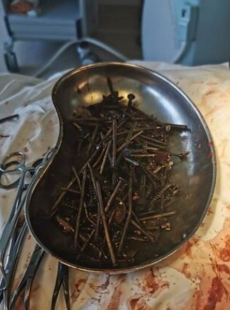 Surgeons in Lithuania impressively removed the metal objects from the patient's stomach