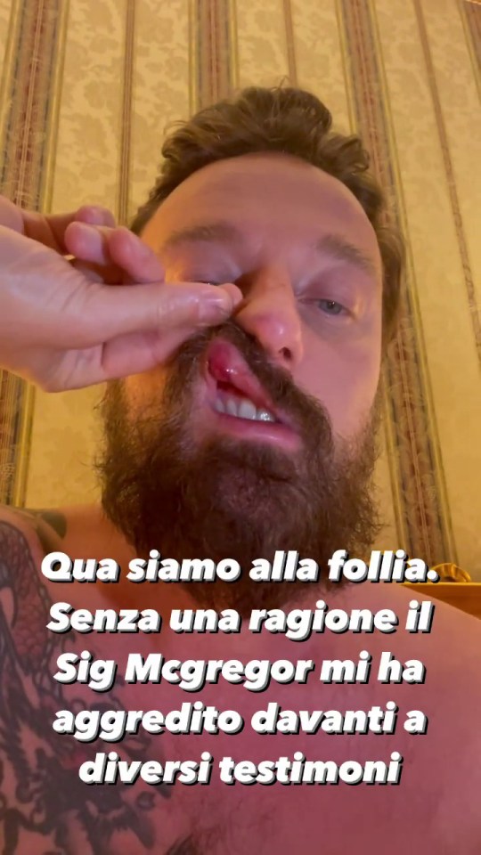 Francesco Facchinetti showed off his damaged life after the confrontation