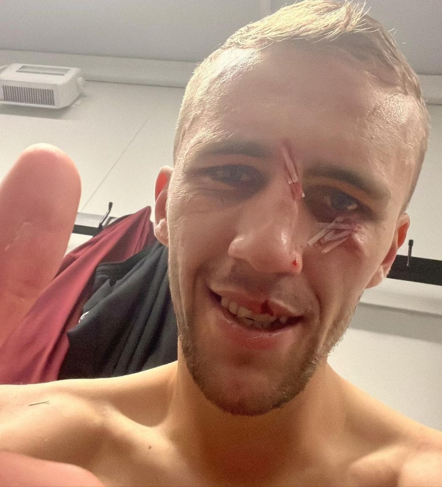 The Hammer shared a picture of his battered face after the match