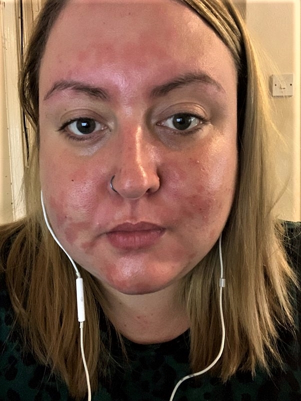 The mum says her skin hurts her confidence