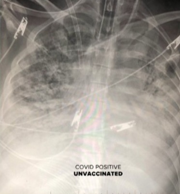 The lungs of a Covid patient who did not get a vaccine