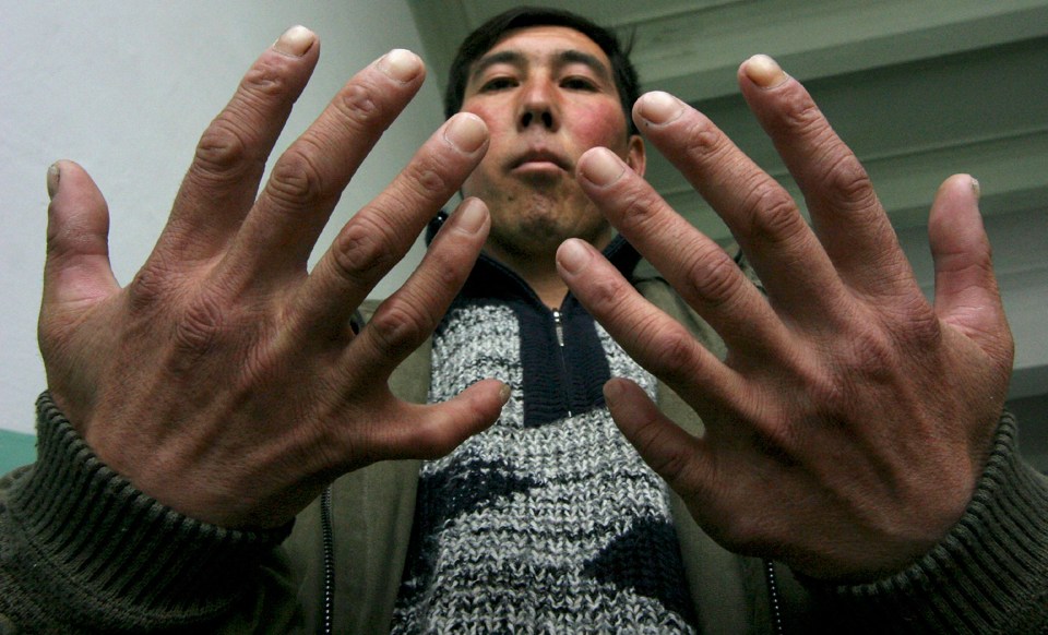 Azamat Kazizov was born with 12 fingers and 12 toes