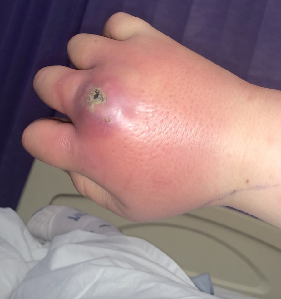 Morgan's bite started to swell over the course of two days and a black spot erupted under her knuckle