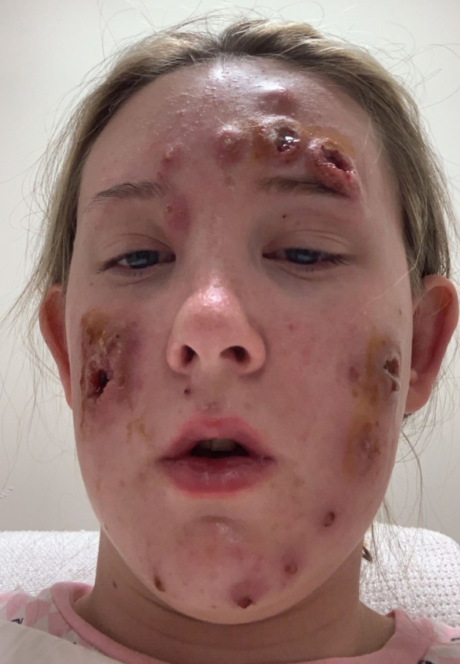 Gaping bloody holes cover Kirsten's face thanks to a rare skin condition