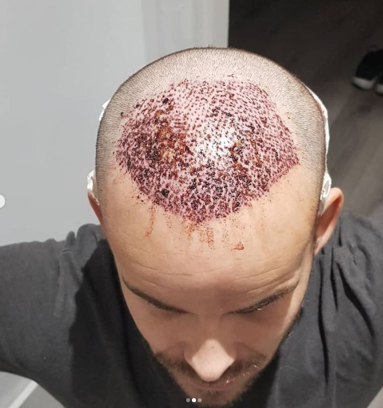 He shared a gory post-op photo of his head