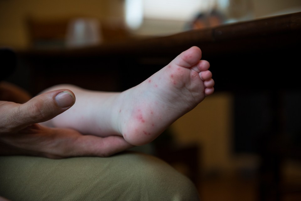 Spots and blisters can sometimes develop on the hands and feet