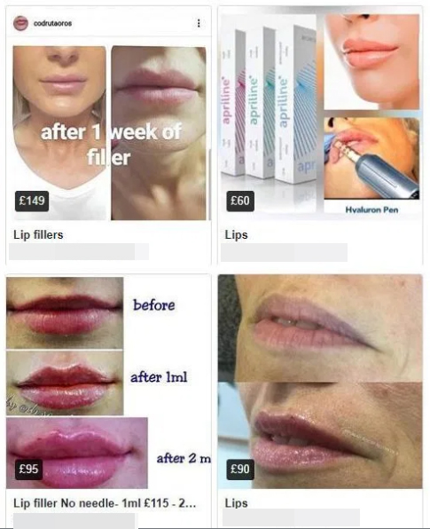 Hundreds of sellers are advertising lip fillers on Marketplace