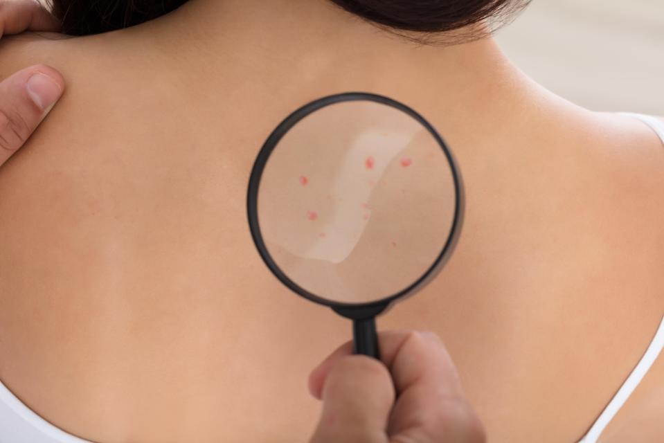 Itchy skin can be one of the first signs of skin cancer to spot