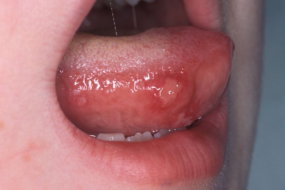 The disease can cause spots and ulcers to appear on the tongue and inside the mouth