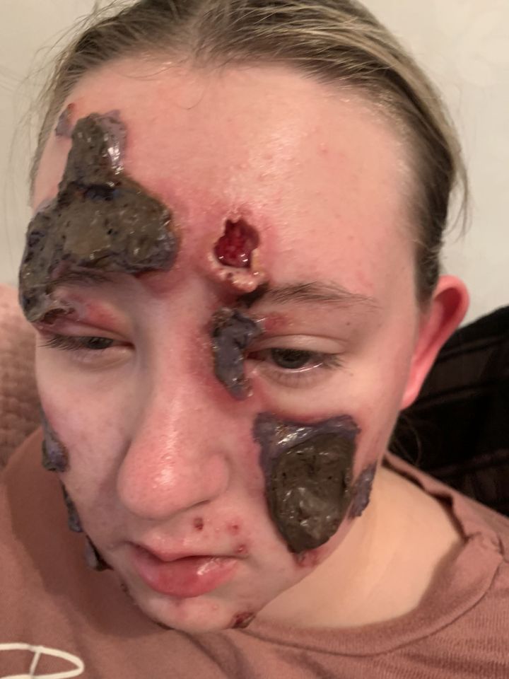 Kirsten has no idea what caused her condition, thought to be pyoderma gangrenosum