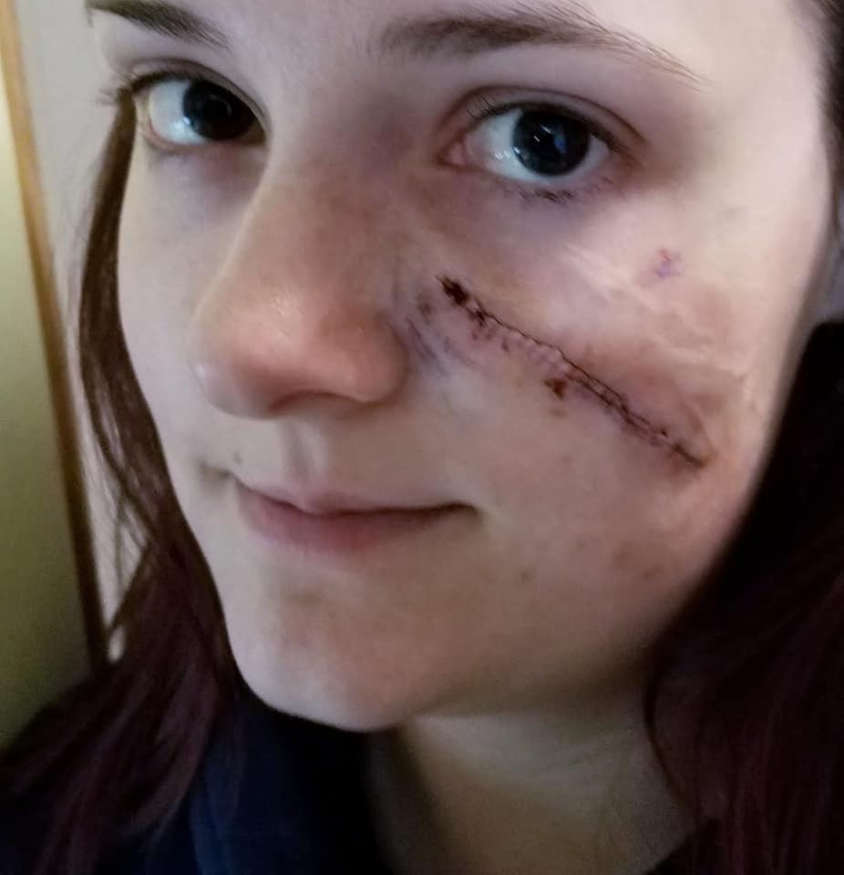 The young woman had the cancer cut out of her face