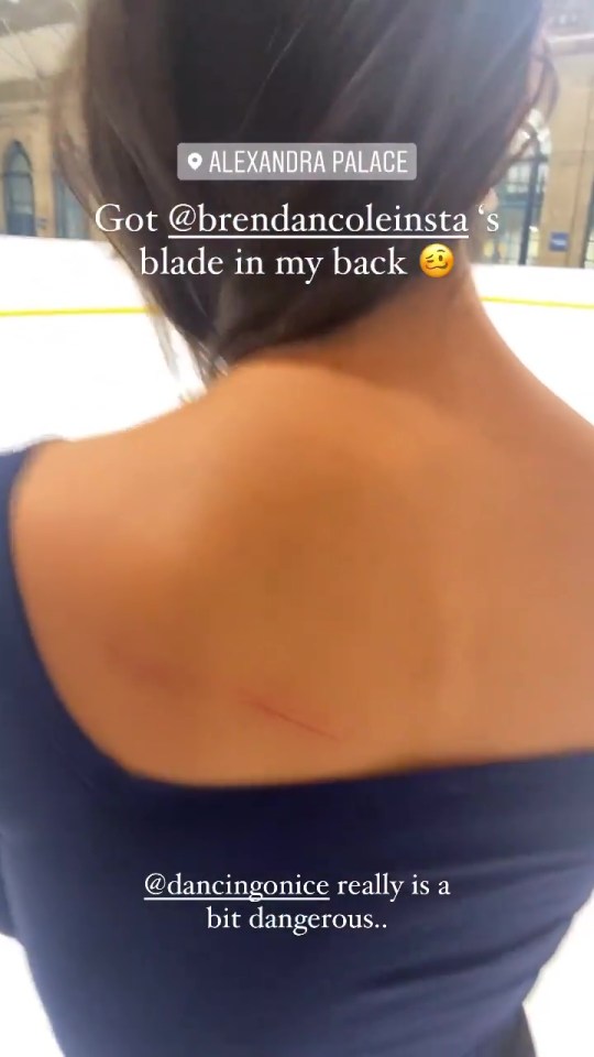 Pro-skater Vanessa shared the accidental injury caused by Brendan Cole's ice skate