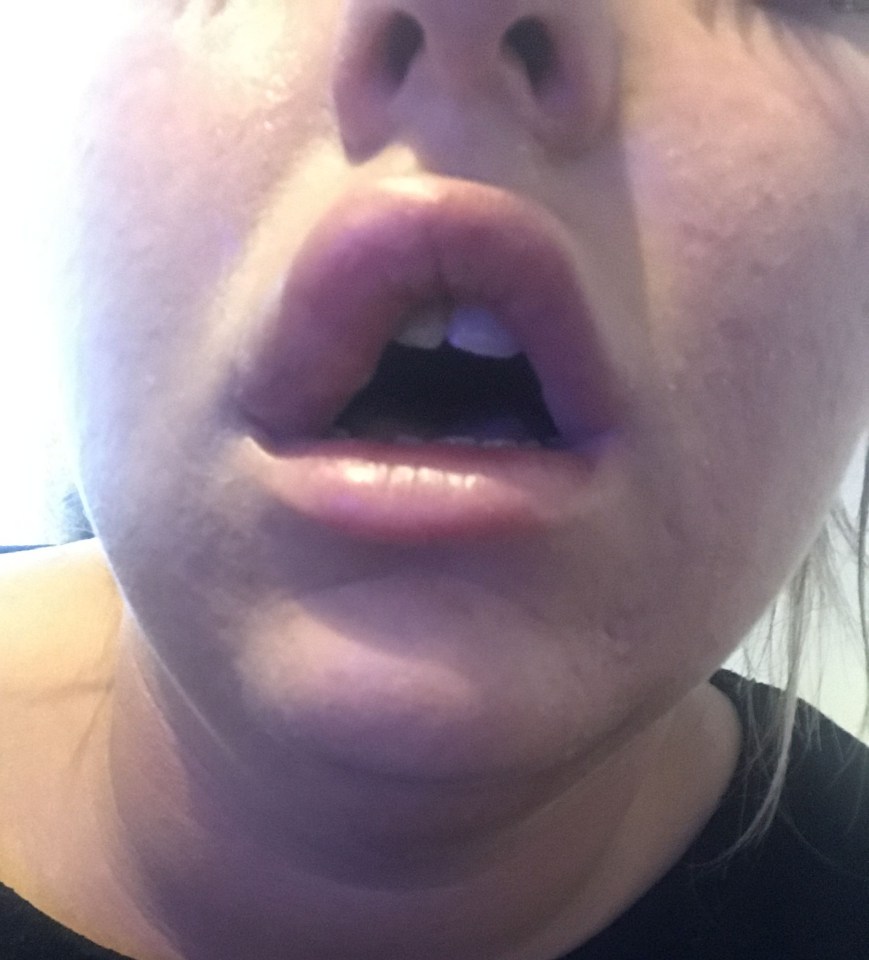 Alex says she sent pictures to her lip filler practioner who said her lips looked "healthy". But a private doctor asked to see her urgently, saying she feared there was no blood supply to the lip