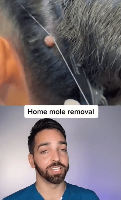 Dr Muneeb Shah (@dermdoctor) says you should never remove a mole at home or let your barber do it. This could possibly allow undiagnosed skin cancer to spread