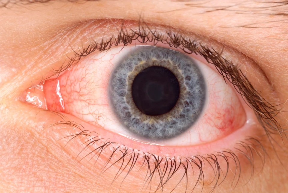 Pink eye could be one of the less common symptoms caused by Omicron