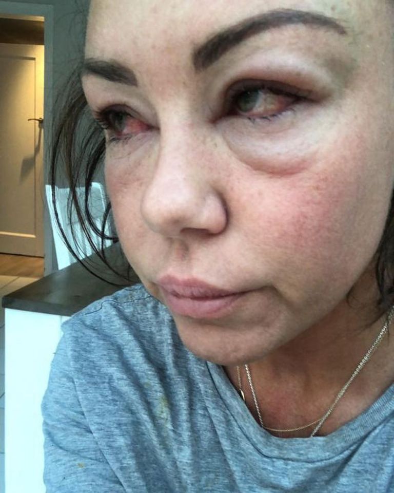 She also reposted a shocking image of her with swollen bloodshot eyes earlier this year