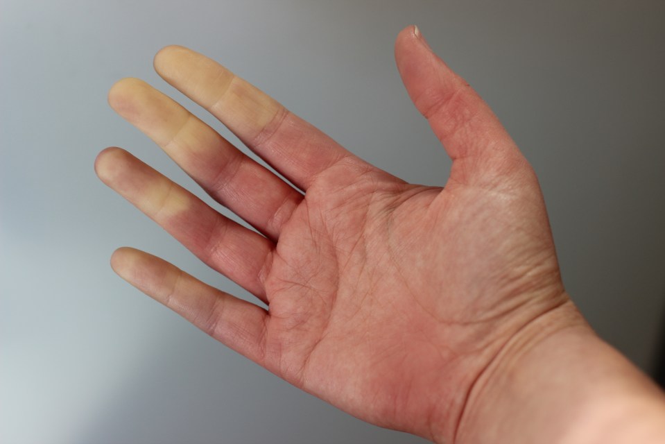 Raynaud's syndrome is usually triggered by cold weather and icy temperatures but can also be brought on by a bout of anxiety or stress