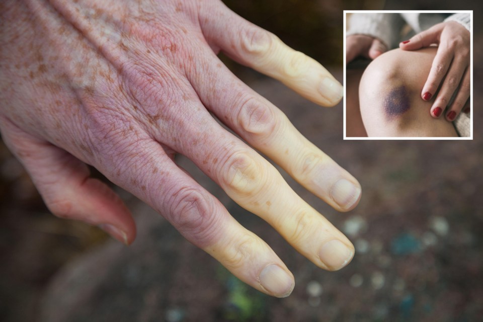 Cyanosis - blue skin - can be a sign of bruising, as well as Raynaud's disease and heart failure