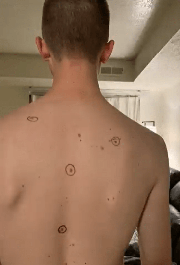 Brinlee Miles sent her husband to the doctor with circles around the moles she was concerned about