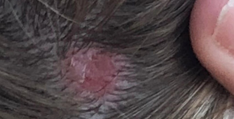 The 36-year-old spotted a sore patch on her scalp, which she said gradually got worse